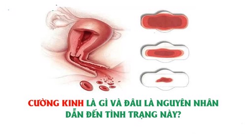 Cường kinh là gì và đâu là nguyên nhân dẫn đến tình trạng này?